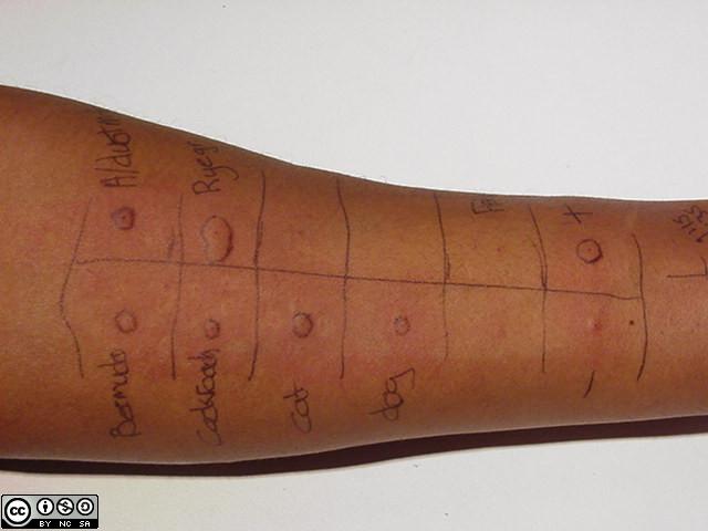 outcomes-of-skin-prick-testing